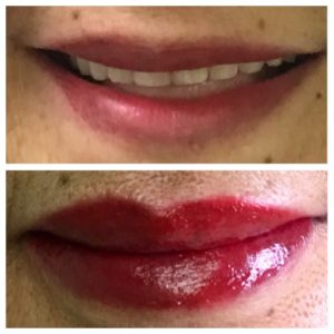 Lip Enhancement